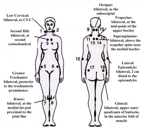 18 trigger points fibromyalgia diagram