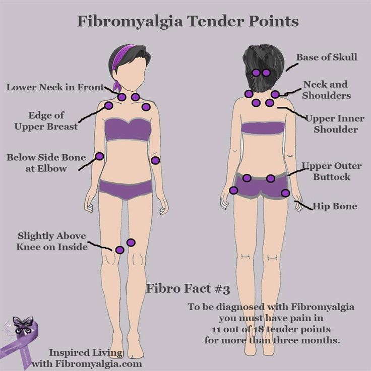 18 trigger points fibromyalgia diagram