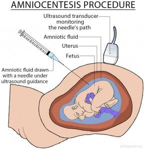 amniocentesis diagram