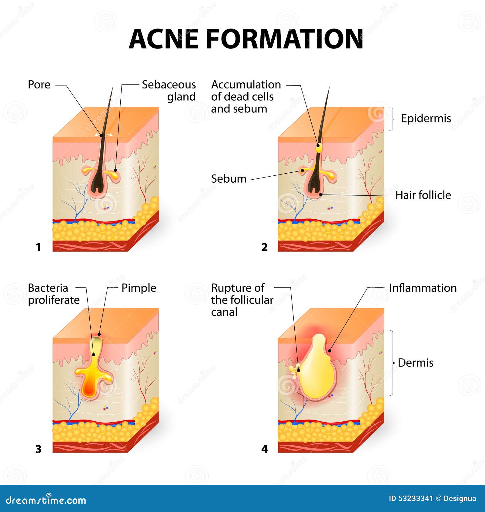 blind pimple diagram