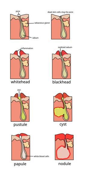 blind pimple diagram