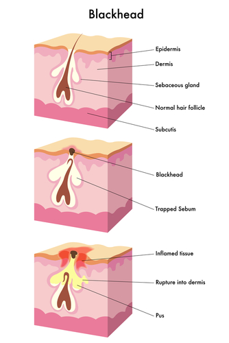 blind pimple diagram