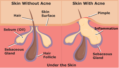 blind pimple diagram