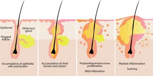 blind pimple diagram