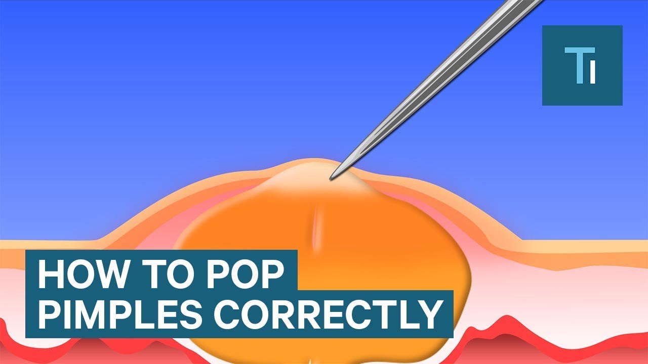 blind pimple diagram