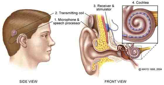 cochlear implant parts diagram