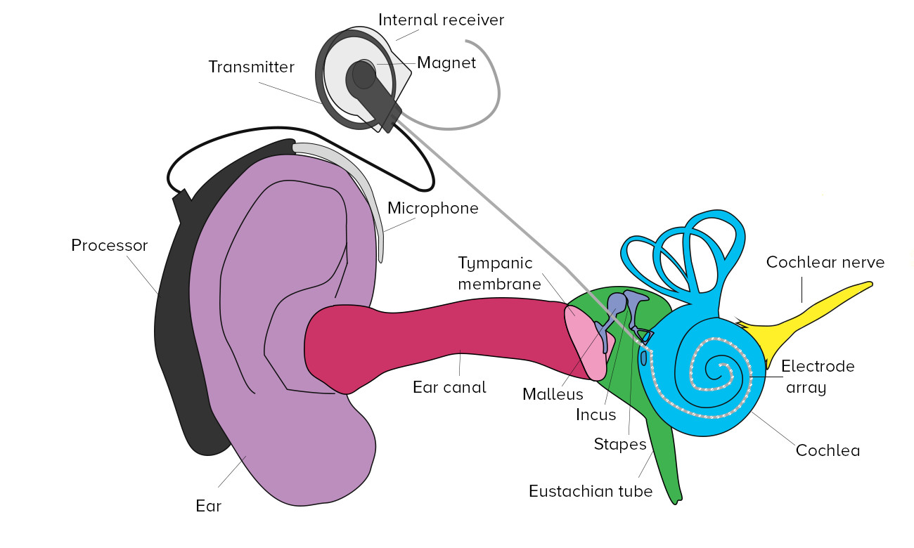 cochlear implant parts diagram
