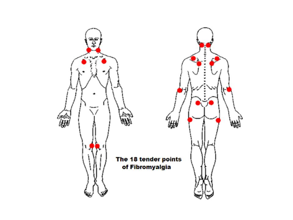 cupping points diagram