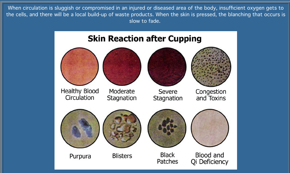 Cupping Points Diagram - Wiring Diagram Pictures