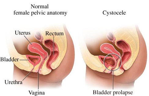 cystocele diagram