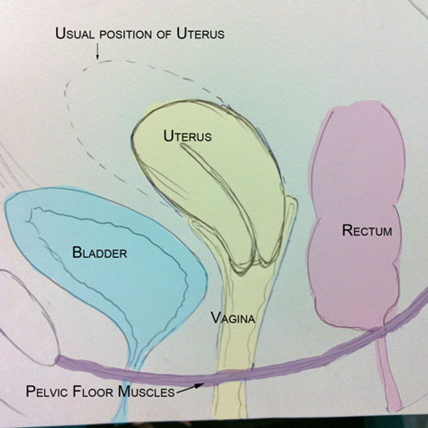 cystocele diagram