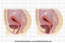 cystocele diagram