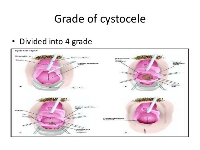 cystocele diagram