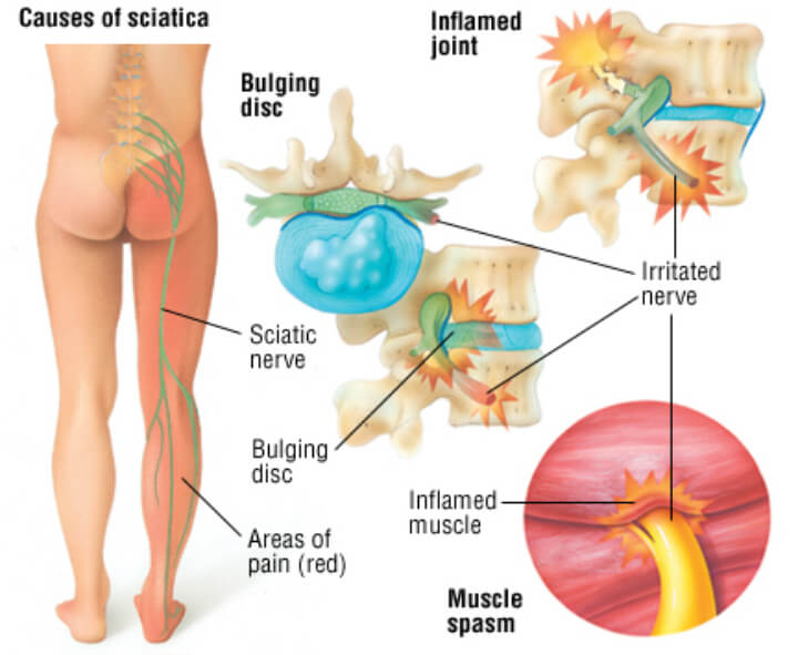 diagram of sciatic nerve pathway
