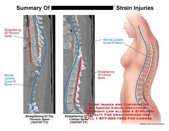 diagram the normal spinal curvatures