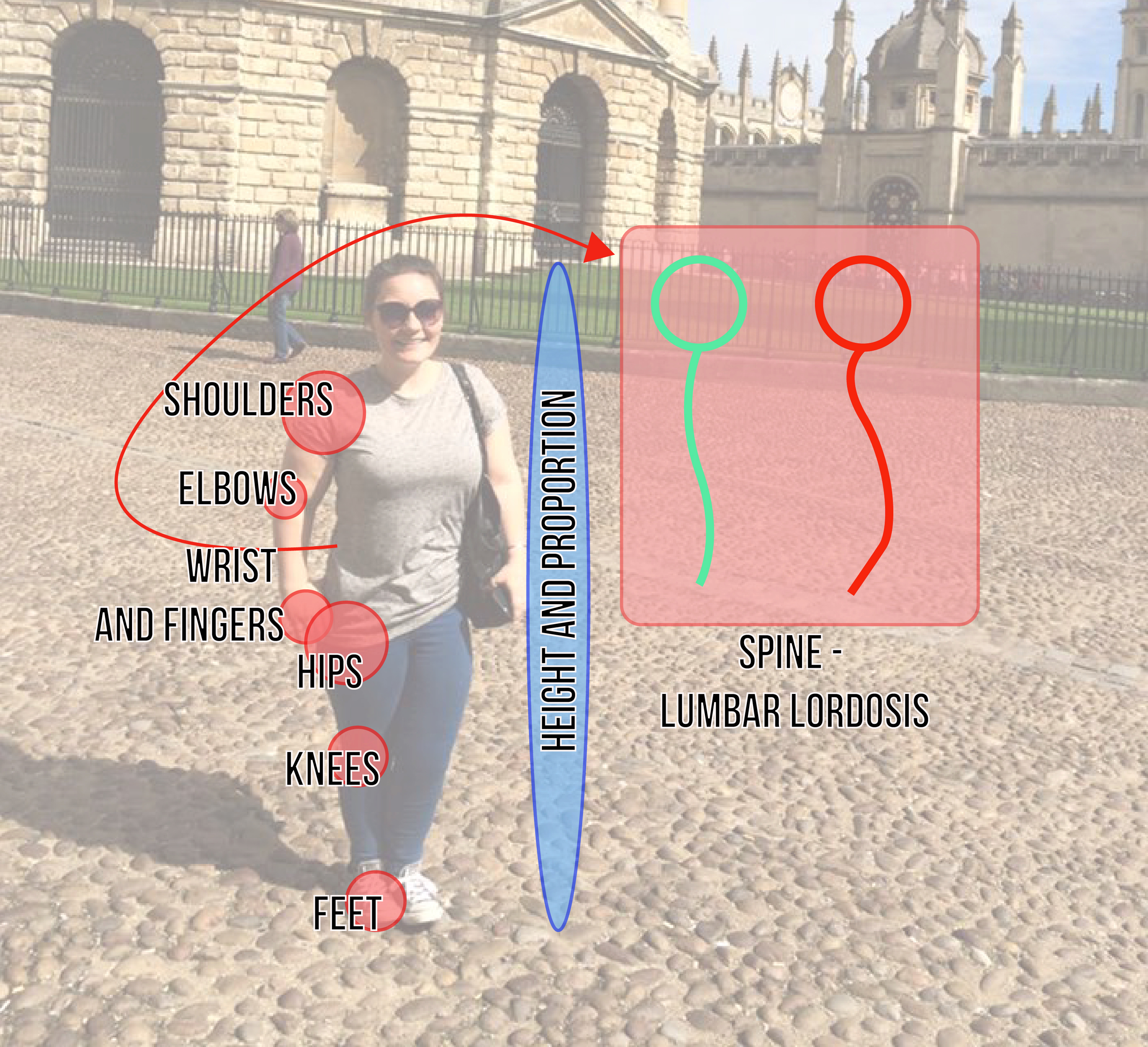 dwarfism diagram