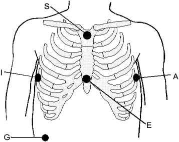 easi lead placement diagram