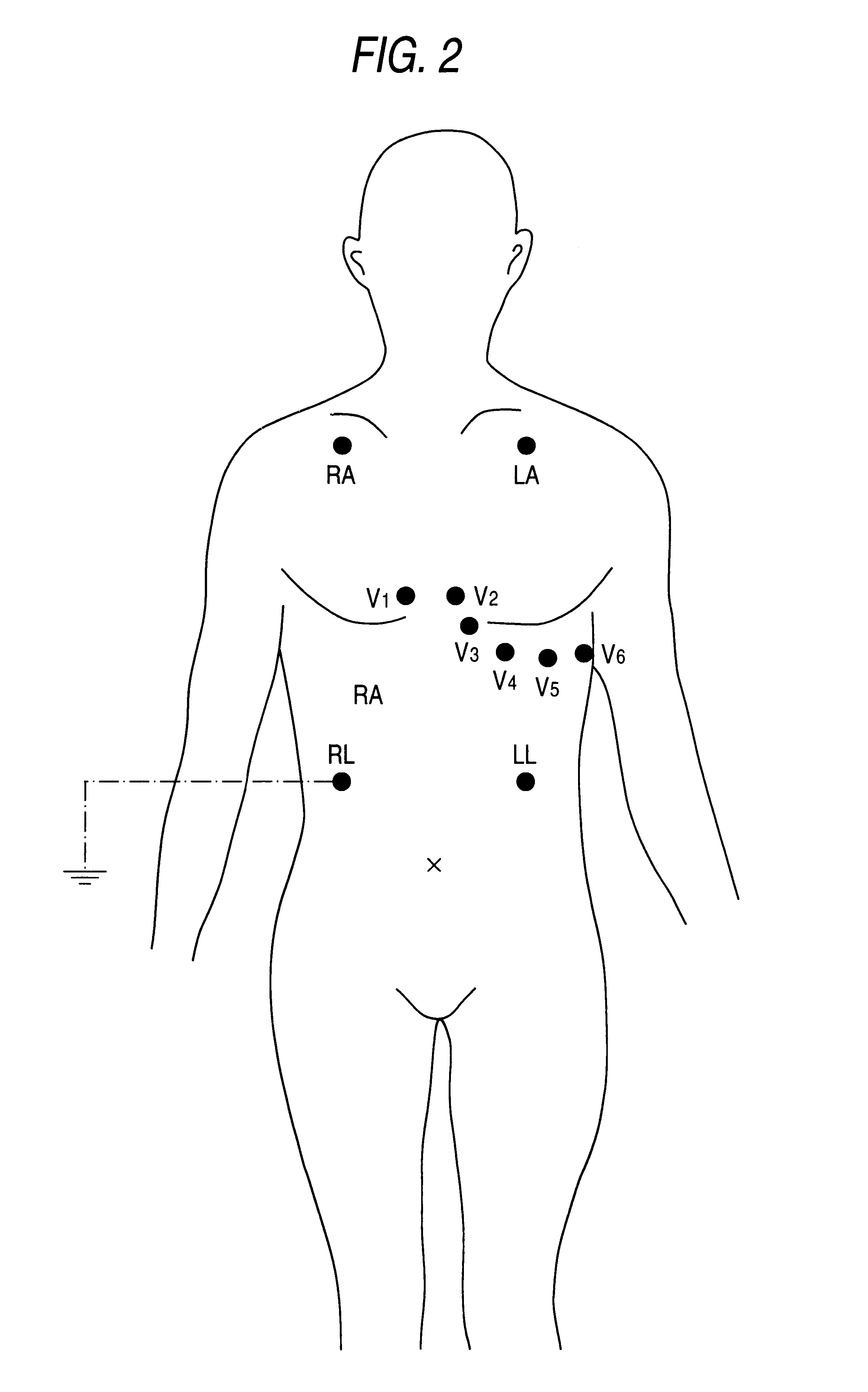 easi lead placement diagram