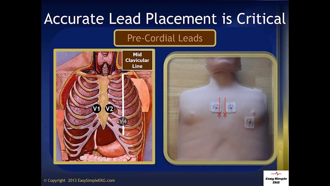 Easi Lead Placement Diagram