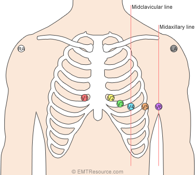 easi lead placement diagram