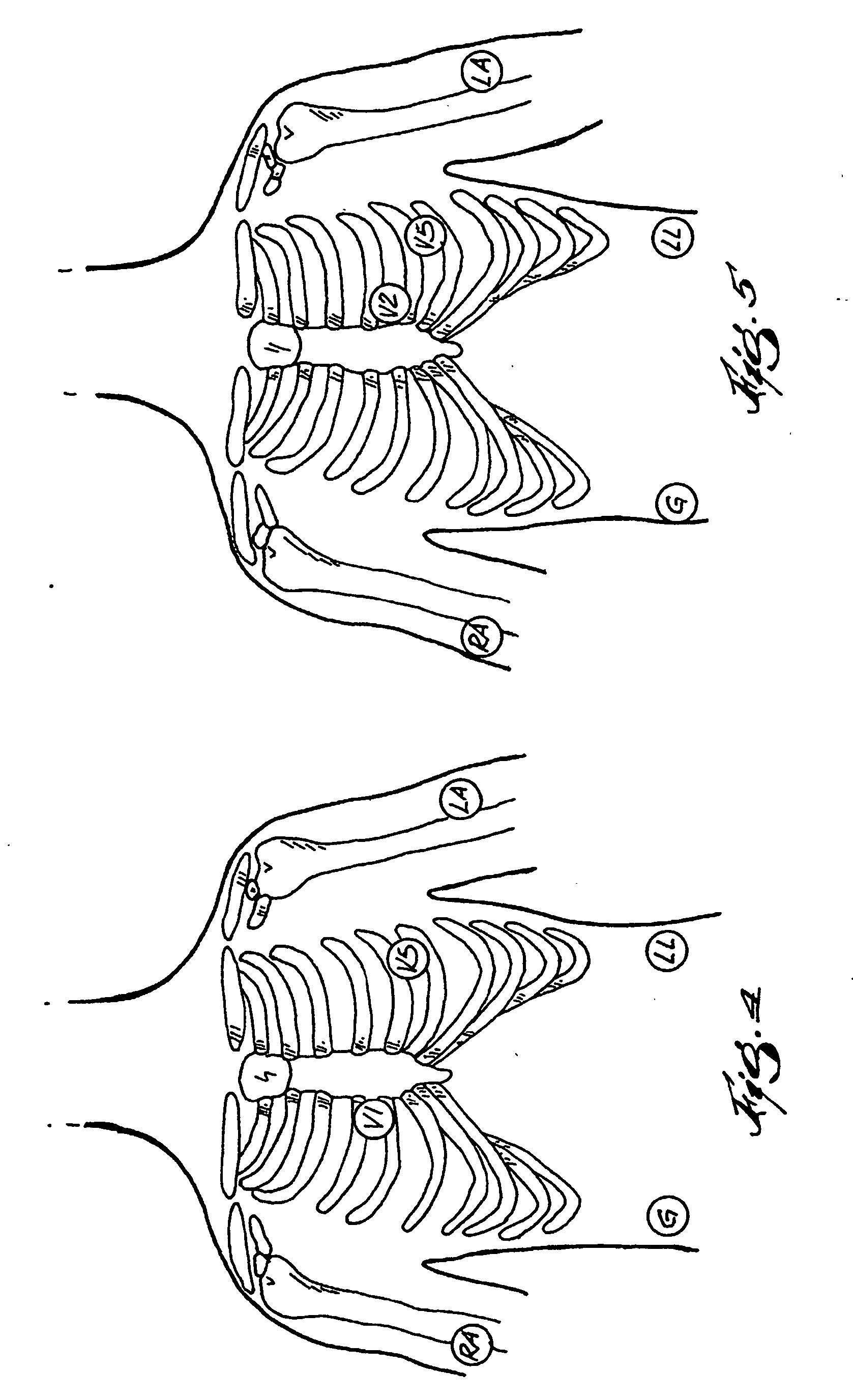 easi lead placement diagram