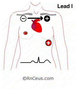 ecg electrode placement diagram