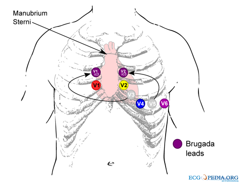 ecg electrode placement diagram