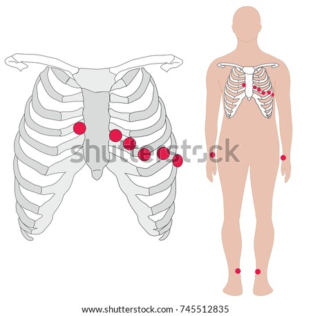 ecg electrode placement diagram