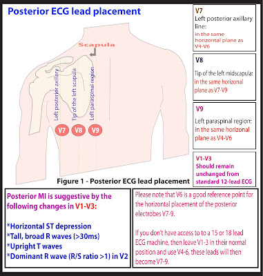 ecg placement leads diagram