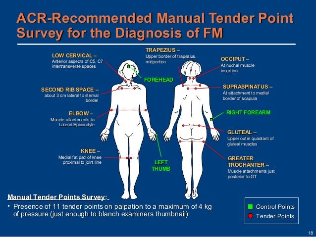 fibro tender points diagram