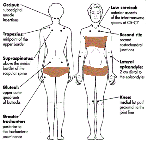 fibro tender points diagram