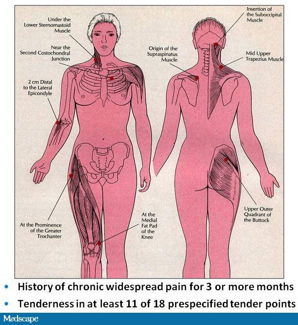 fibro tender points diagram