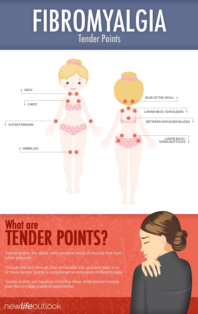 fibro tender points diagram