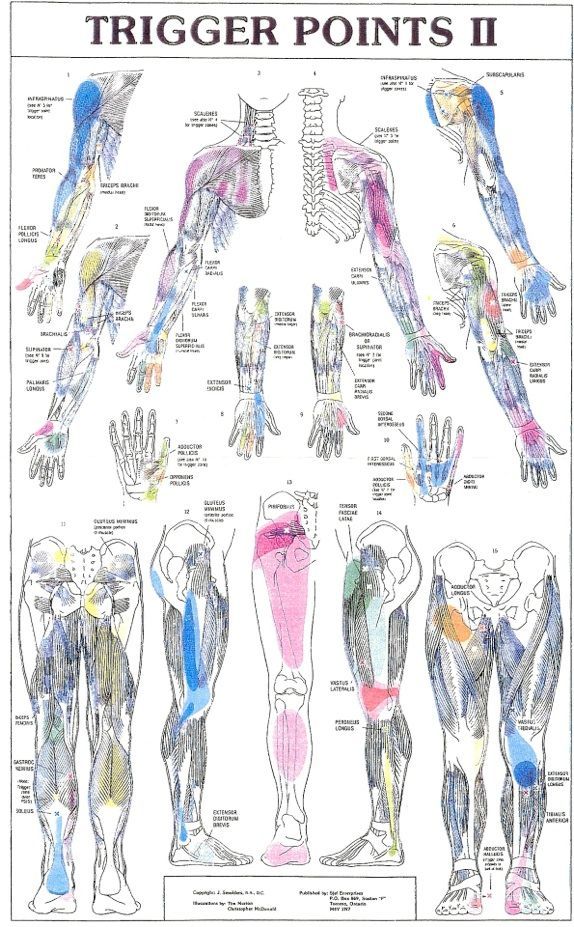 fibro trigger points diagram