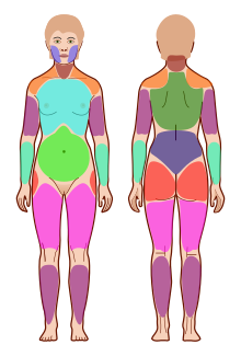 fibro trigger points diagram