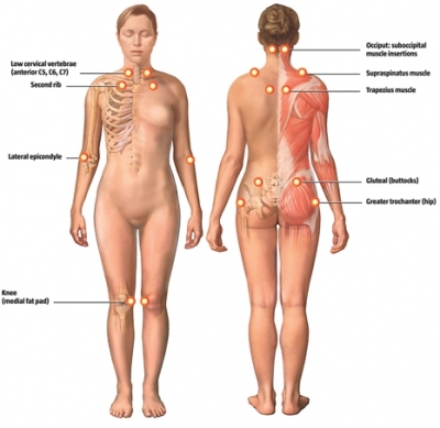 fibro trigger points diagram