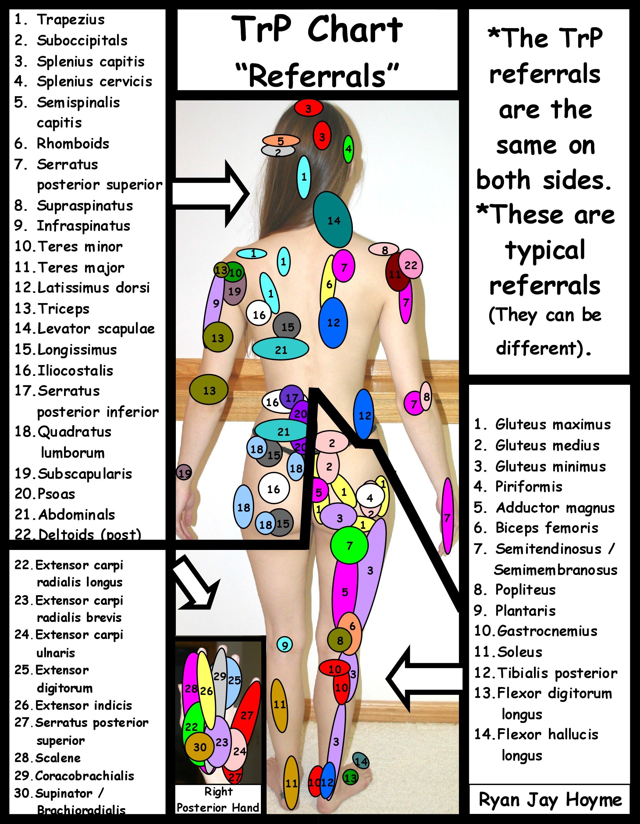 fibro trigger points diagram