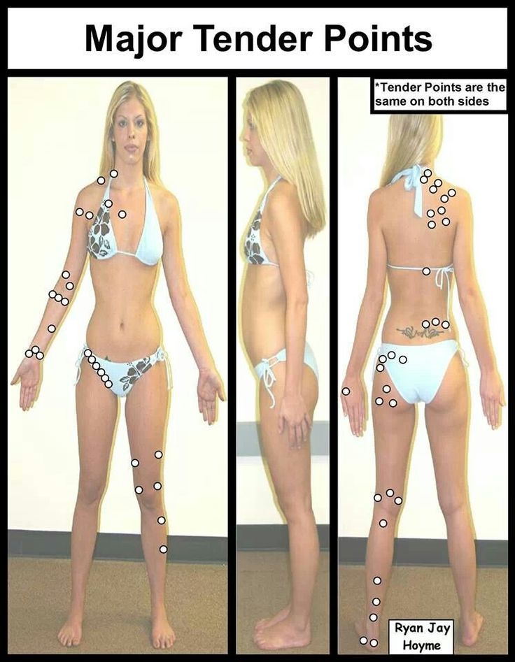 fibro trigger points diagram