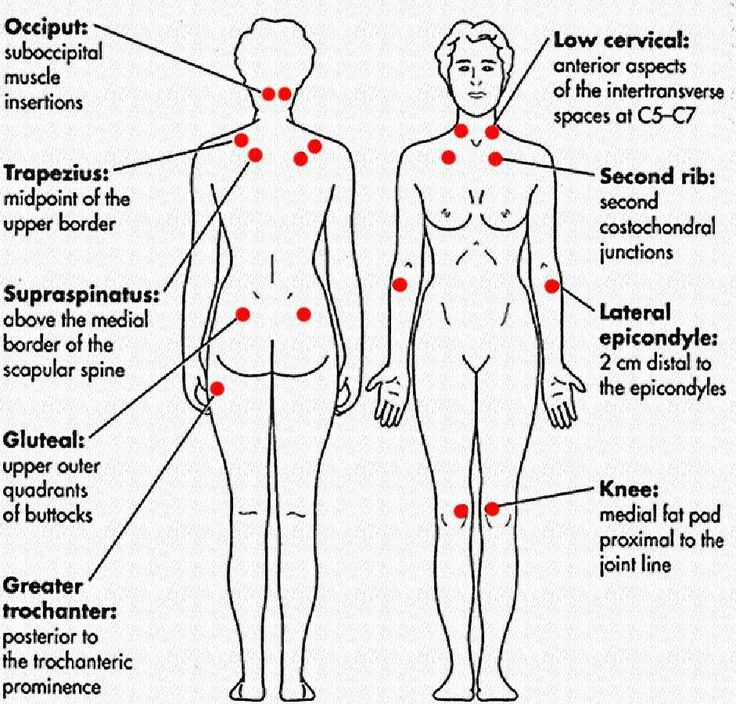 fibro trigger points diagram