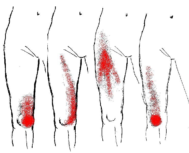 fibro trigger points diagram