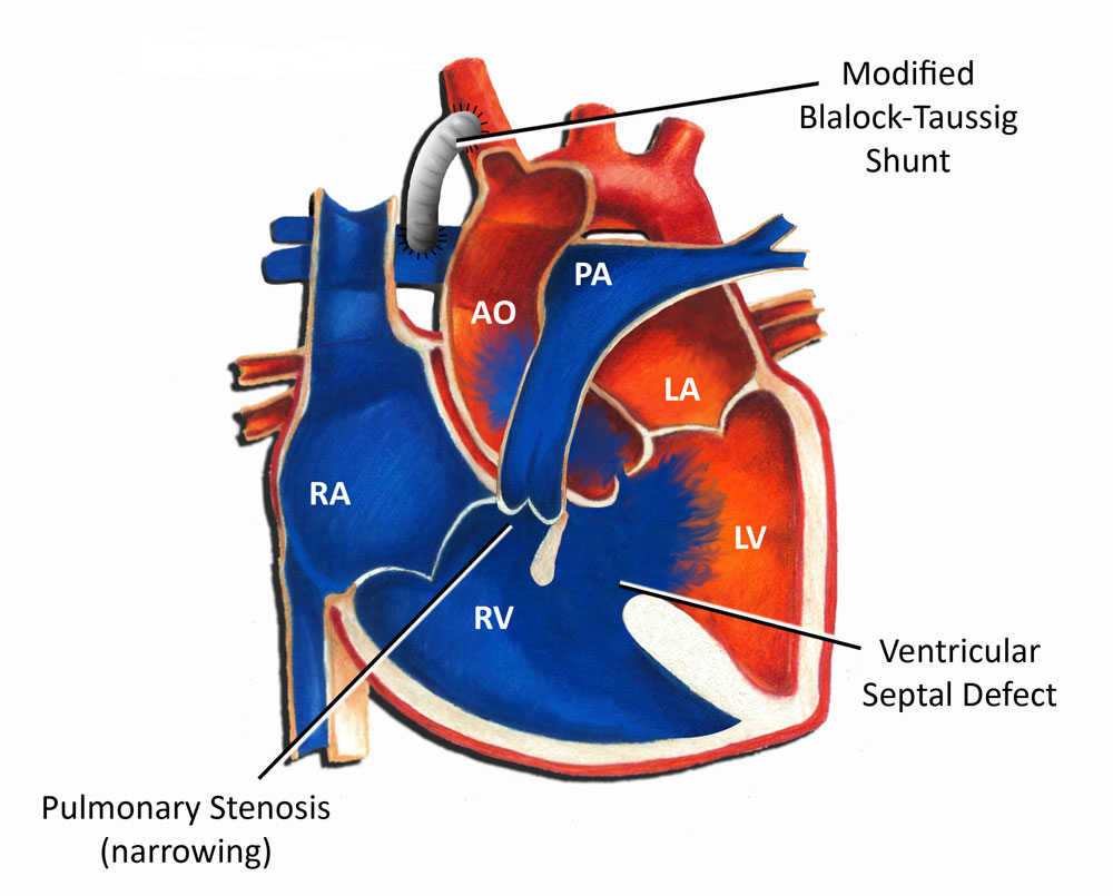 glenn shunt diagram