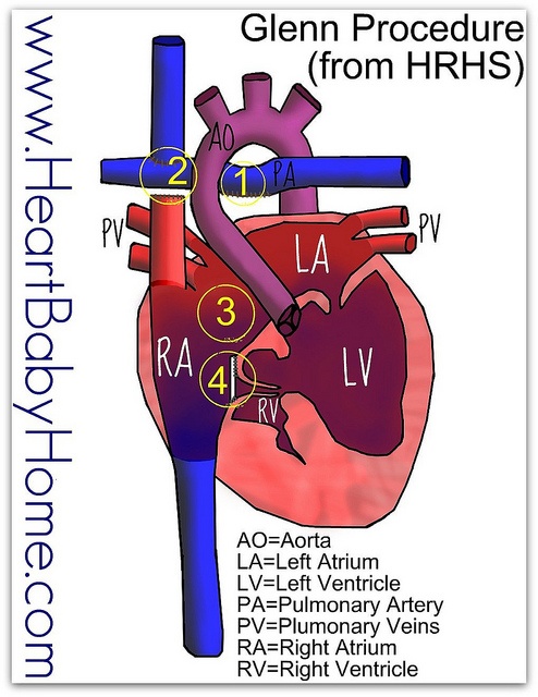 glenn shunt diagram