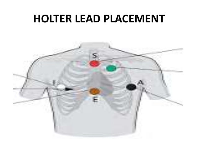 holter monitor lead placement diagrams