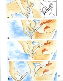 how to insert tampon diagram