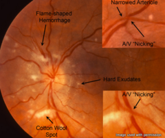 hypertensive retinopathy copper wiring