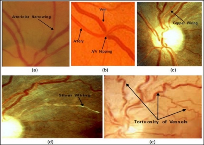 hypertensive retinopathy copper wiring