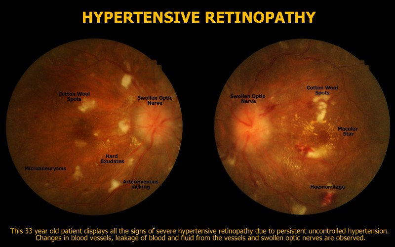 hypertensive retinopathy copper wiring