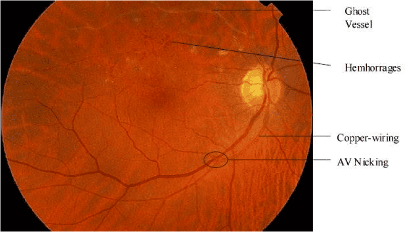 hypertensive retinopathy copper wiring