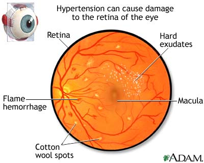 hypertensive retinopathy copper wiring