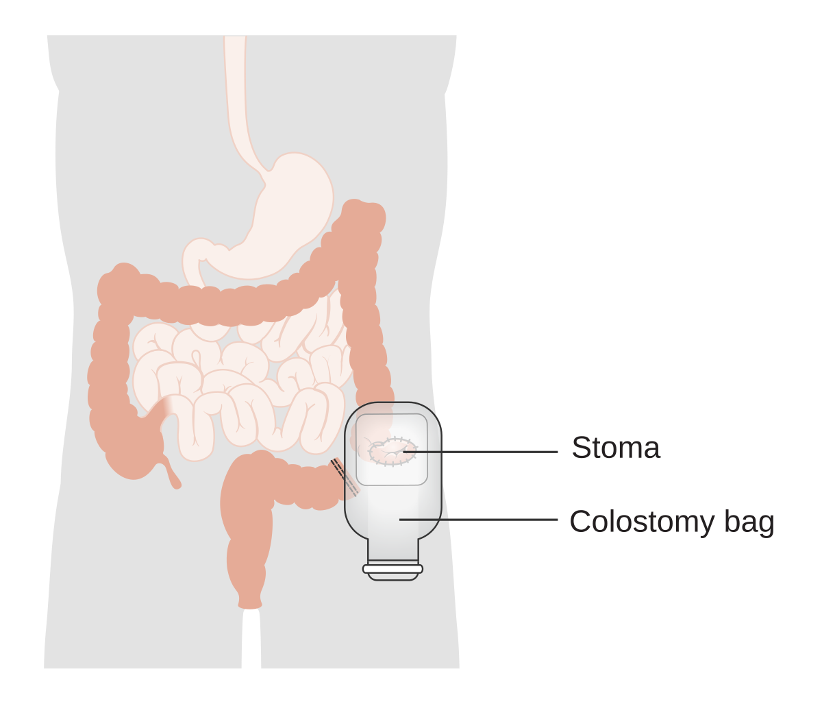 ileostomy diagram